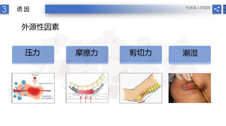 压力性损伤预防及护理PPT