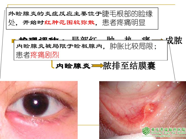 眼睑及泪器的护理PPT