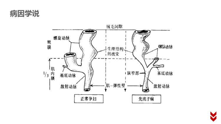 妇产科学妊娠期高血压疾病PPT