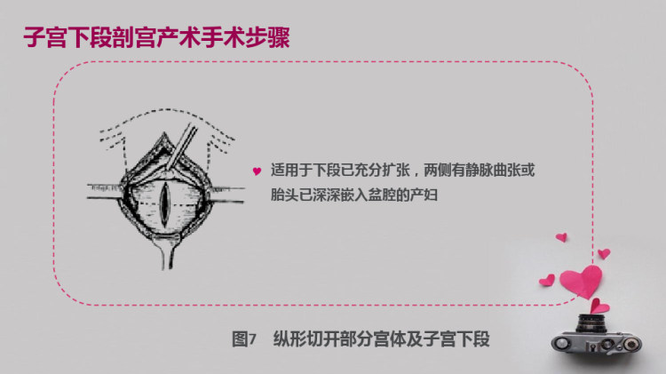 剖宫产术护理与保健PPT