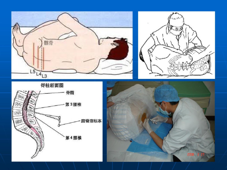 颅内压增高与脑疝PPT