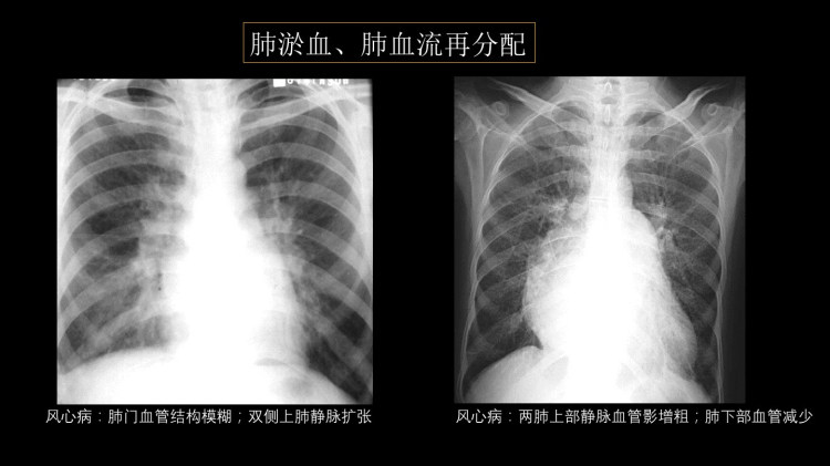 肺血管及肺网状结构影像学与心肺疾病PPT