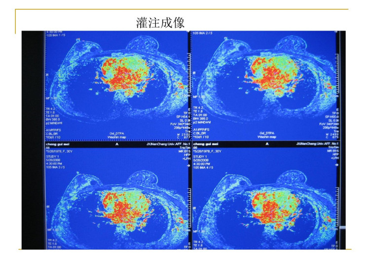 乳腺磁敏感PPT