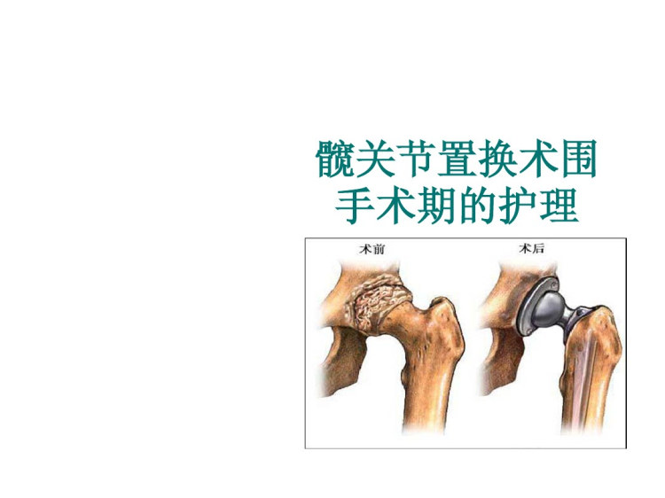 髋关节置换术围手术期的护理PPT