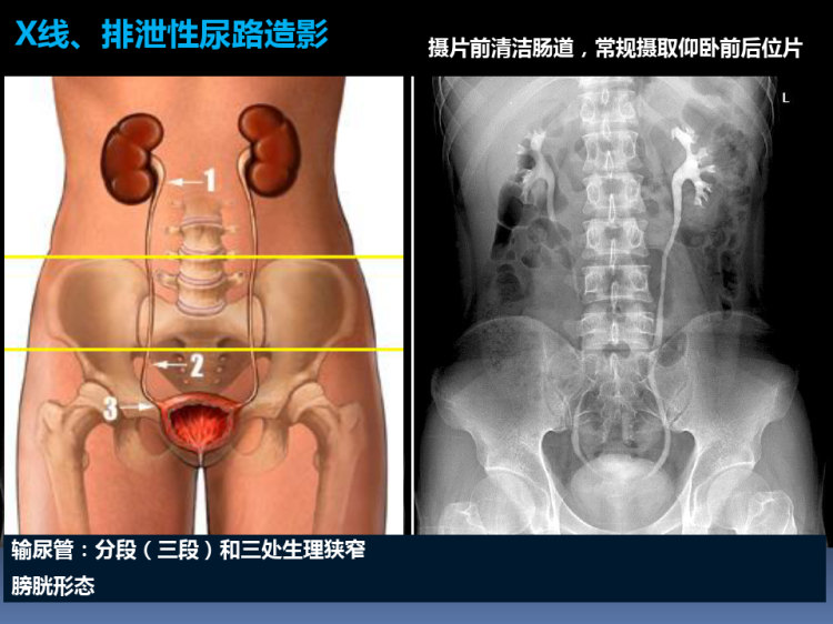 《泌尿系统影像学》PPT课件