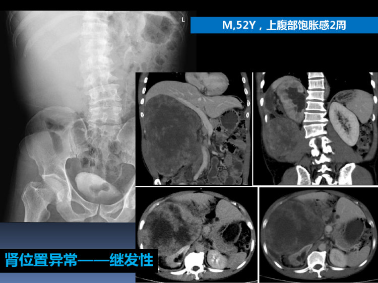 《泌尿系统影像学》PPT课件