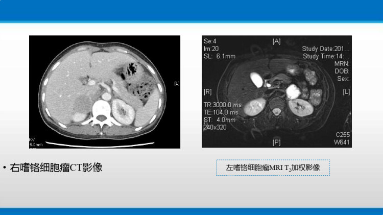 肾上腺疾病的外科治疗PPT