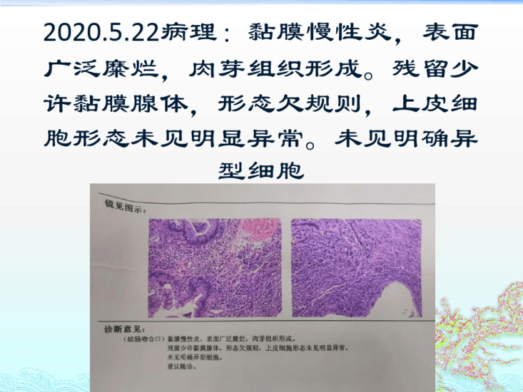 病人陈华病情讨论PPT