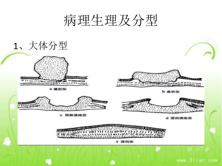 结肠癌病人的护理查房PPT