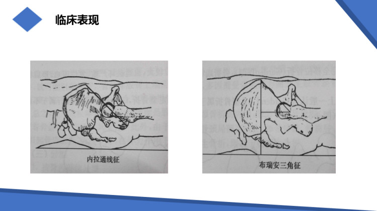 股骨颈骨折培训PPT