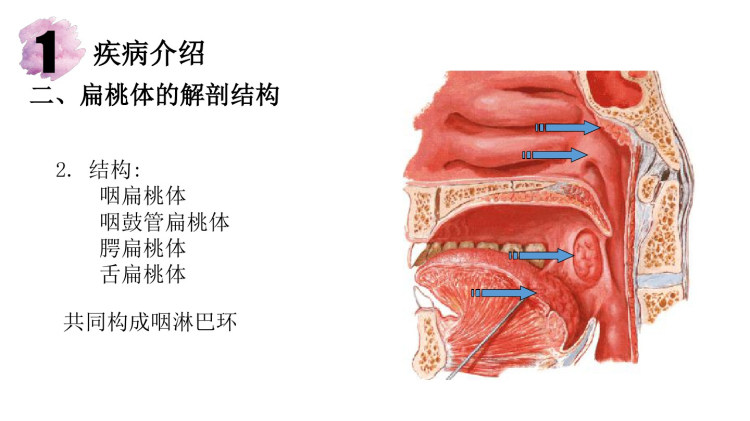 扁桃体摘除术后护理查房PPT