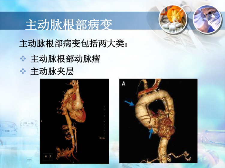 主动脉疾病手术简介PPT