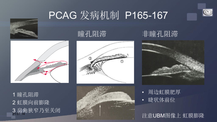 原发性闭角型青光眼复旦精品课程PPT