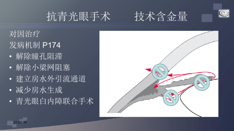 原发性闭角型青光眼复旦精品课程PPT