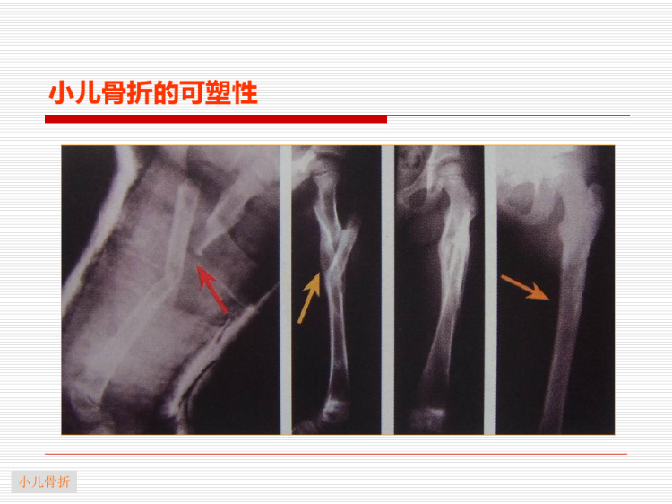 小儿常见骨折及其处理复旦精品课程PPT