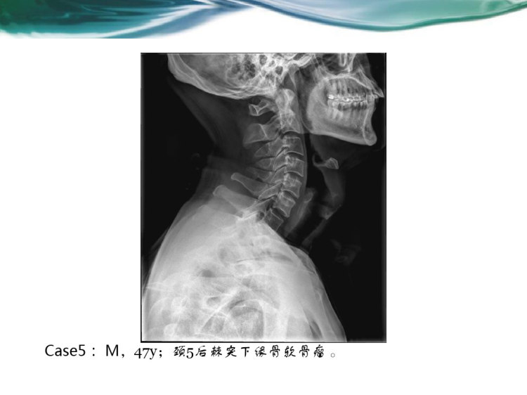 脊柱常见肿瘤及肿瘤样病变影像学表现PPT