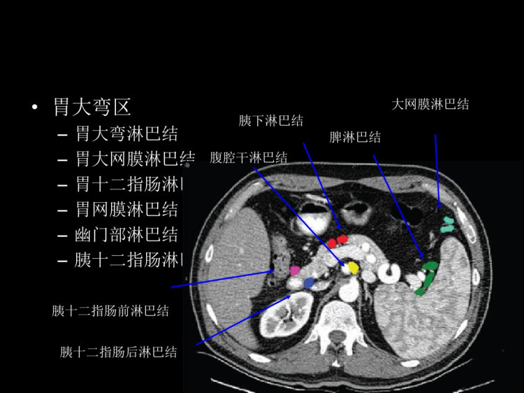腹部淋巴结PPT