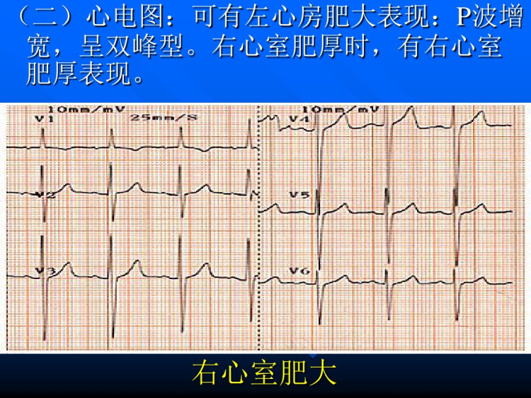 风湿性心脏病PPT
