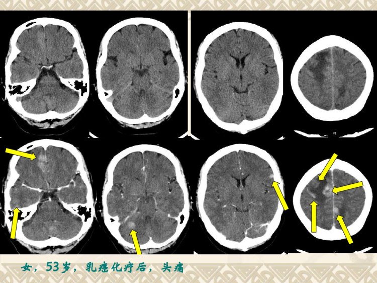 中枢神经系统影像学PPT