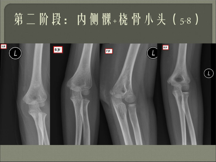 肘关节线常用测量及诊断分析PPT