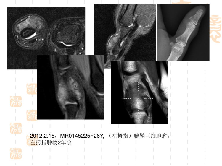 膝关节滑膜病变诊断与鉴别诊断PPT
