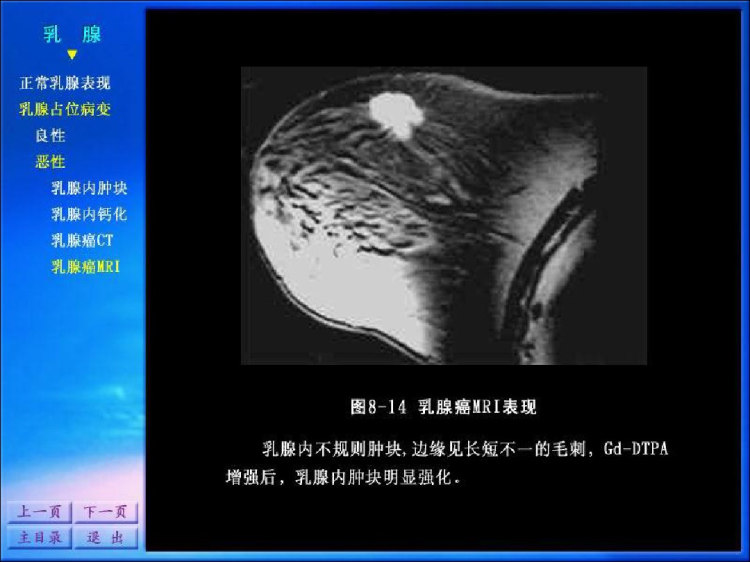 影像诊断学系列图谱生殖乳腺系统PPT
