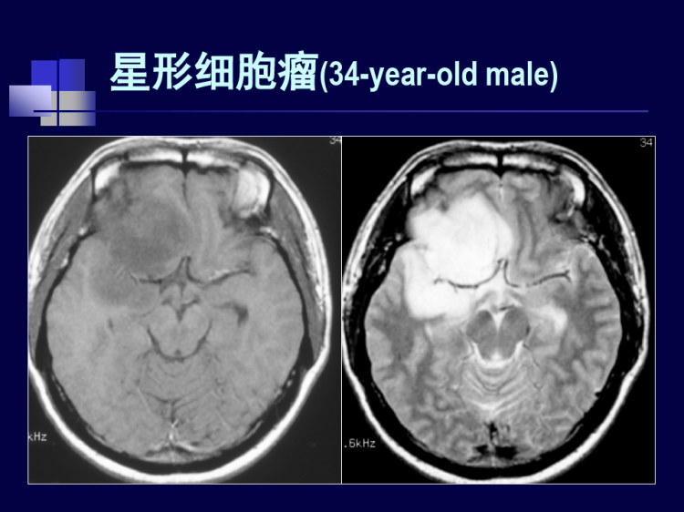 颅脑常见肿瘤影像学诊断PPT
