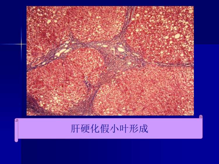 门脉高压8年制PPT