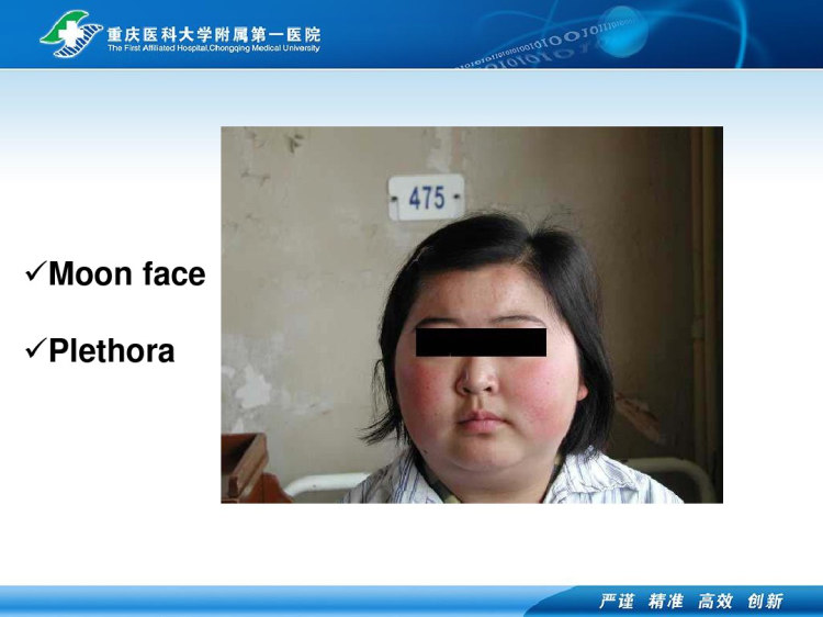 库兴综合征PPT