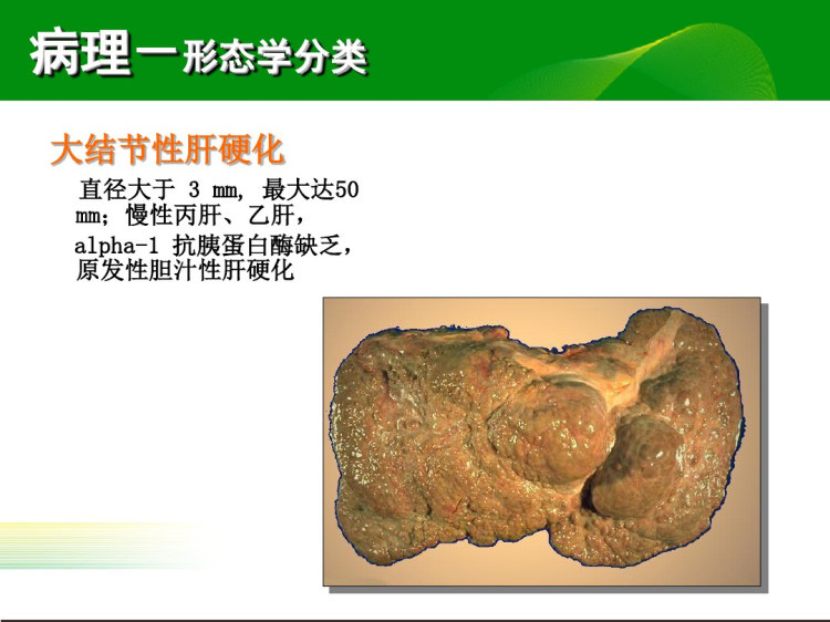 肝硬化PPT