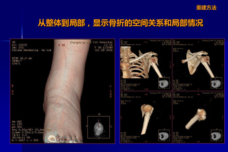 骨折MSCT重建方案PPT