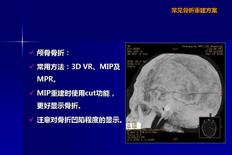 骨折MSCT重建方案PPT