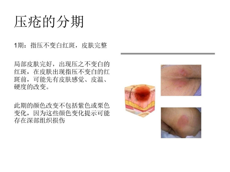 压疮预防PPT