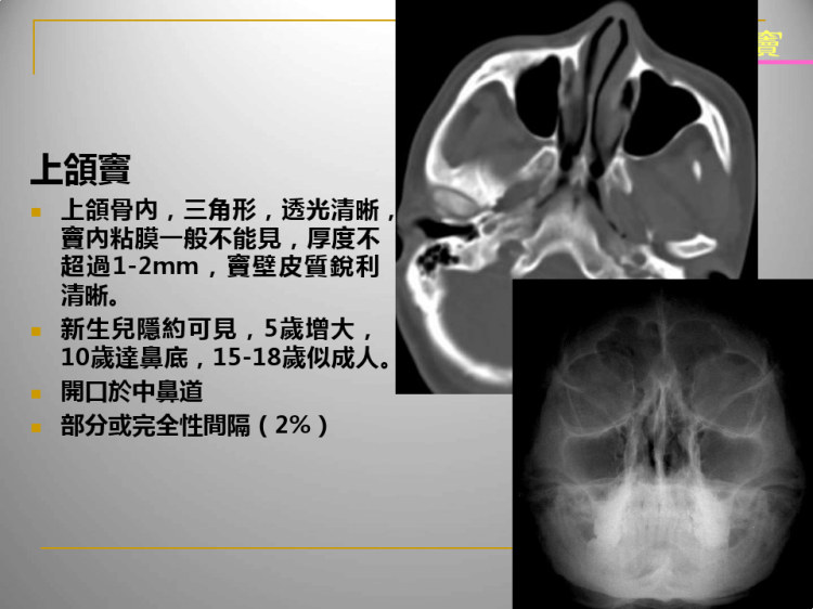 鼻及鼻窦影像诊断PPT