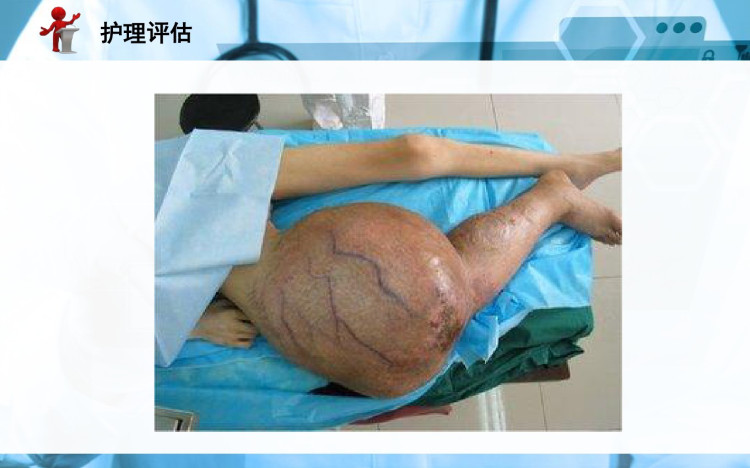 《外科护理学》第二十章 第六节 骨肿瘤病人的护理PPT