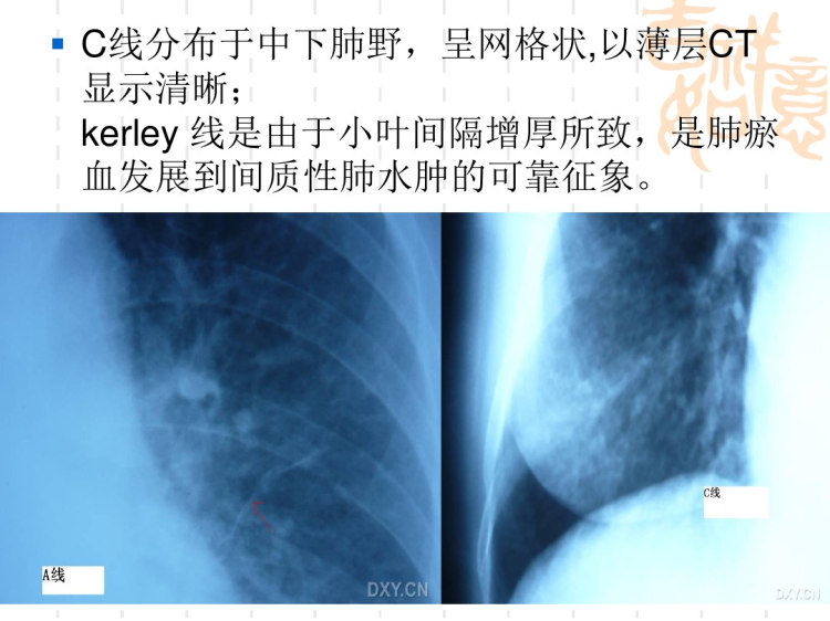 心力衰竭的X线表现PPT课件