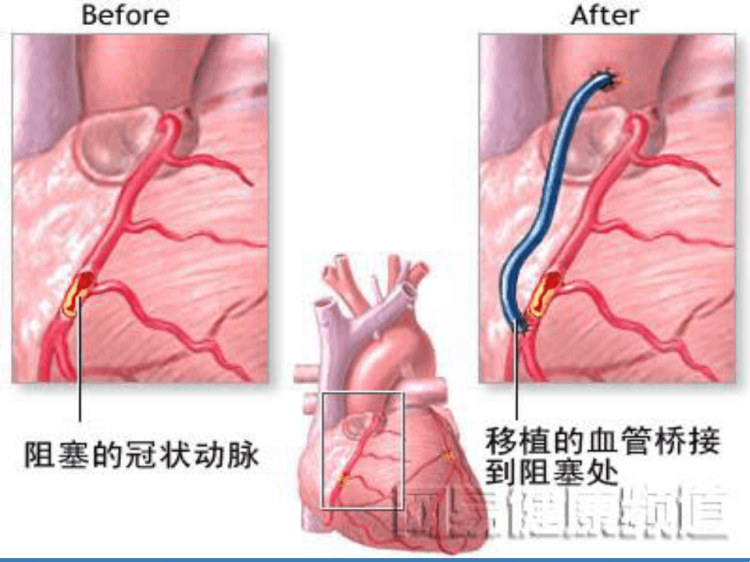 冠脉搭桥术后护理PPT