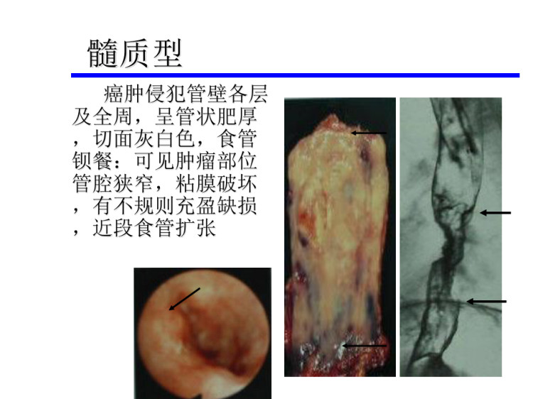 外科学PPT食管癌食管疾病PPT