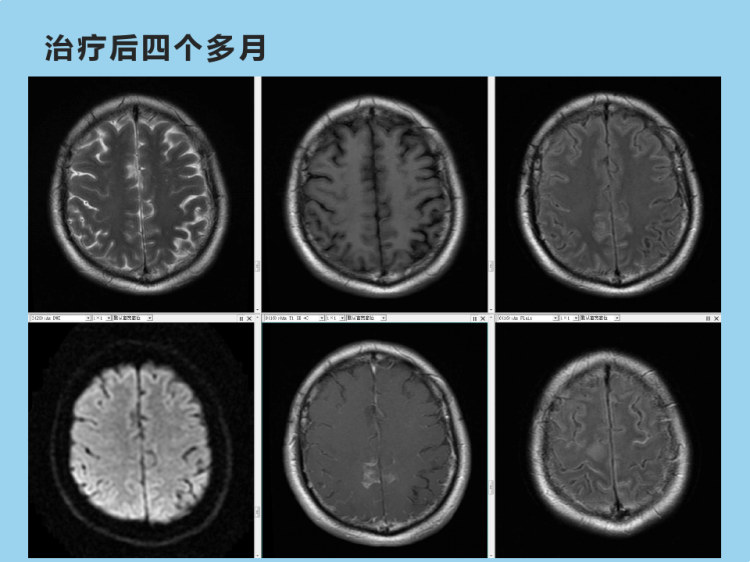 隐球菌性脑膜脑炎的影像表现PPT
