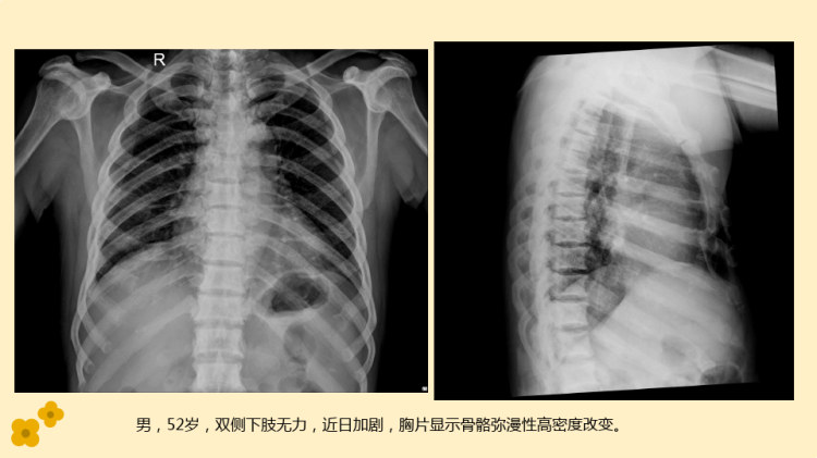 氟骨症的影像表现PPT