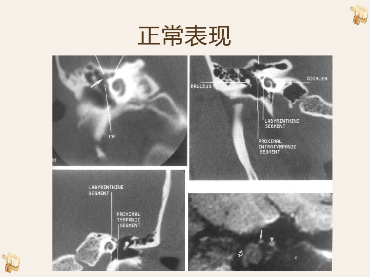 面神经麻痹病因的影像学诊断PPT