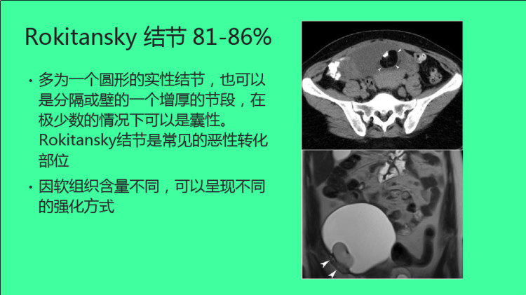 卵巢畸胎瘤的影像学表现PPT