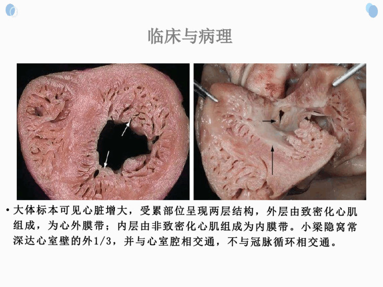 心肌致密化不全的影像诊断与鉴别诊断PPT