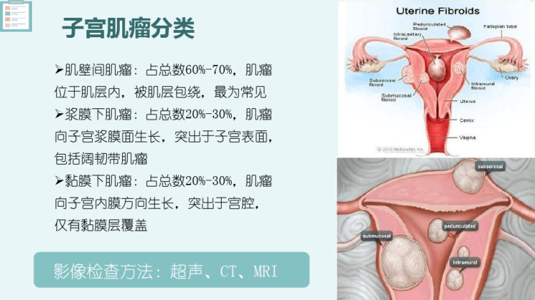 子宫肌瘤与子宫腺肌瘤的影像表现PPT