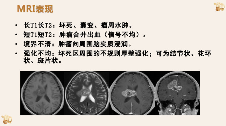 颅内胶质母细胞瘤的影像诊断与鉴别诊断PPT