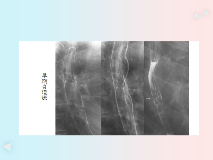 食管平滑肌瘤和食管癌影像诊断及鉴别诊断PPT