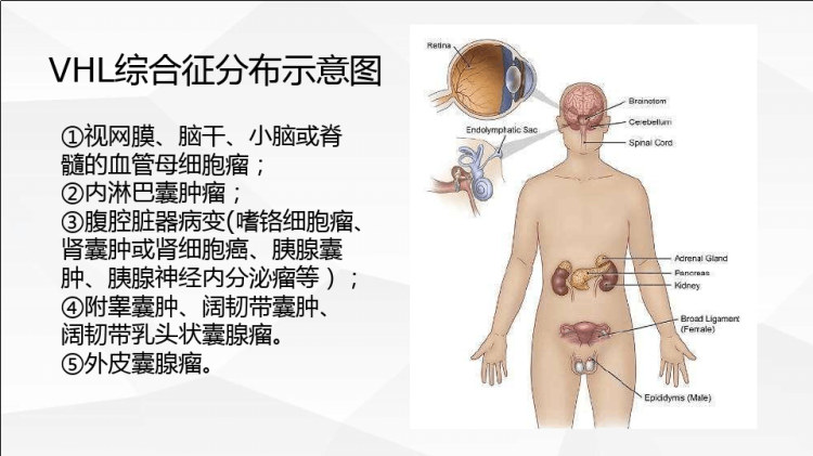 vhl冯希佩尔林道综合征的影像诊断与鉴别诊断PPT