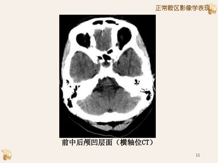 鞍区病变的影像诊断与鉴别诊断PPT