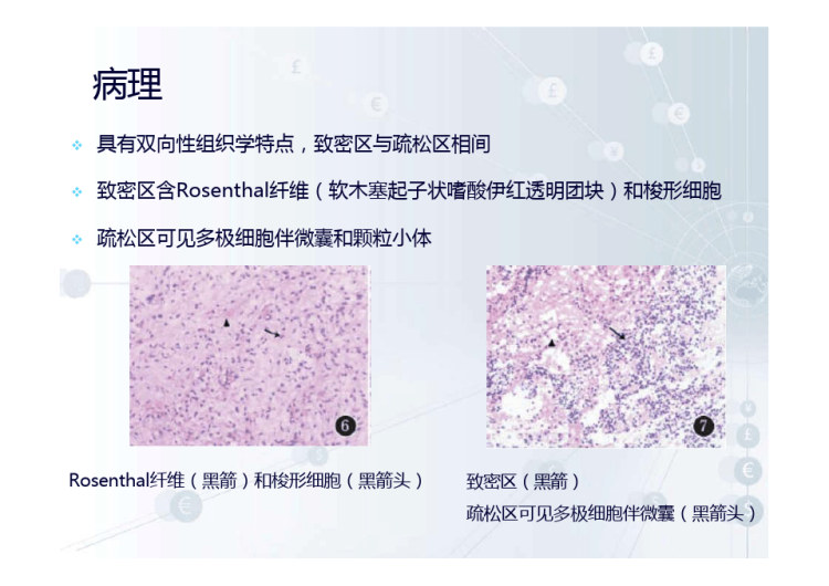 鞍区毛细胞型星形细胞瘤的影像诊断与鉴别诊断PPT