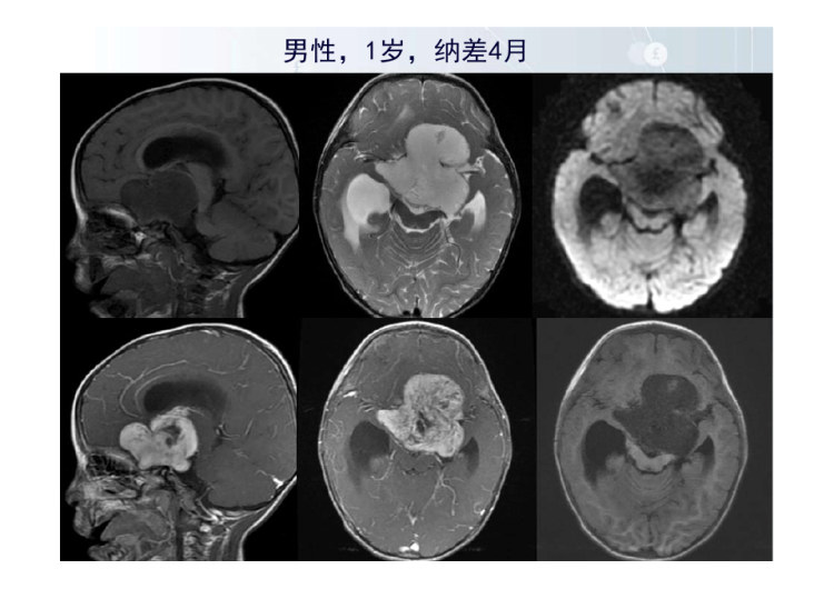 鞍区毛细胞型星形细胞瘤的影像诊断与鉴别诊断PPT